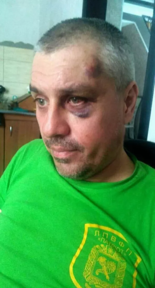 Вячеслав Артюхов со следами побоев Ненависть законами не поборешь. Хочешь избавиться от соседа – просто объяви его